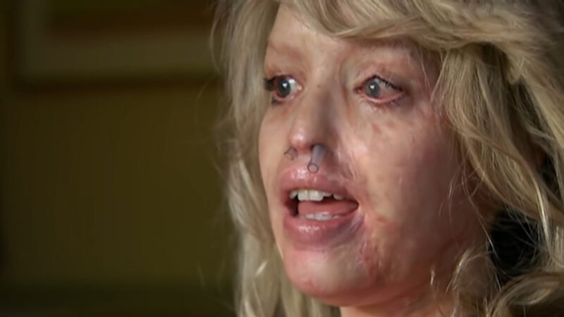 kate paper face after acid in March 2008