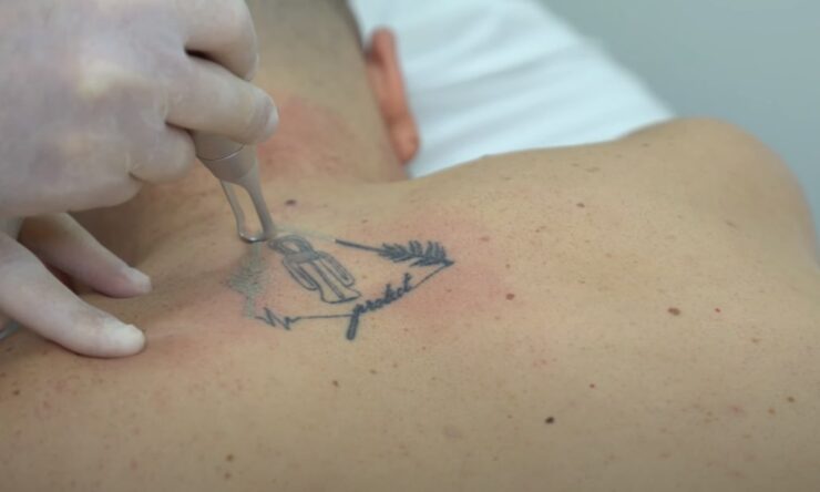 Preparation for Tattoo Removal