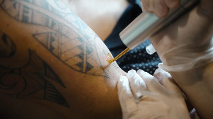 What is Tattoo Removal