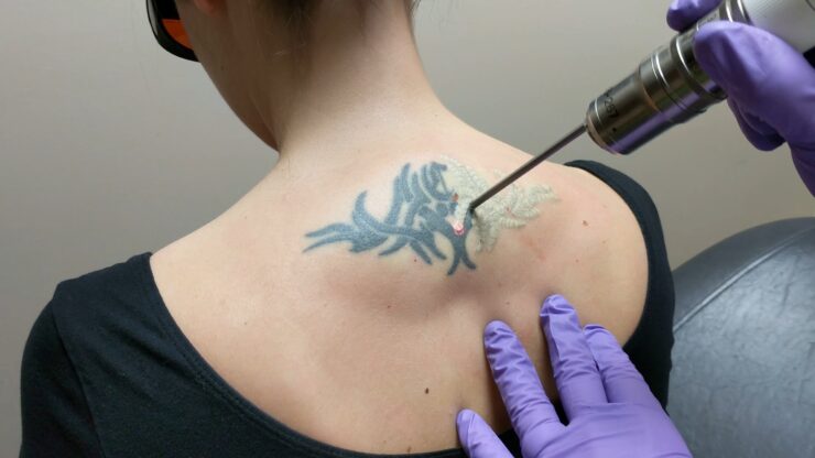 why people choose tattoo Removal